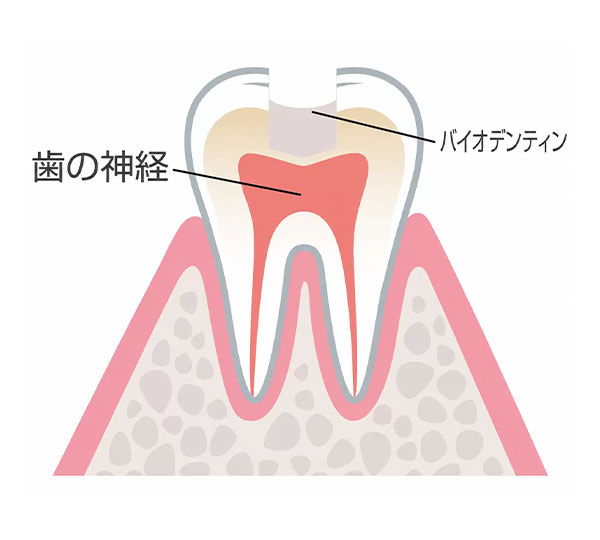 間接覆髄法