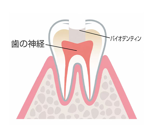 直接覆髄法