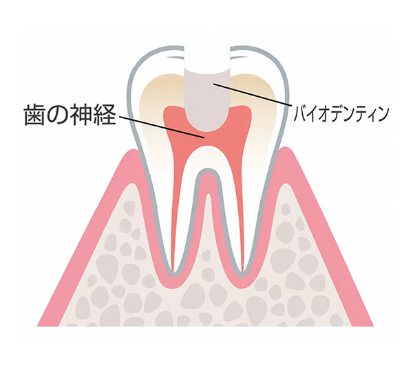 部分断髄法
